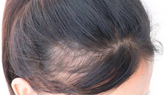kraftigt håravfall hos kvinnor